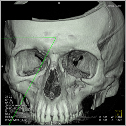 Orbital Fracture - CTisus CT Scan