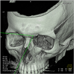 Orbital Fracture - CTisus CT Scan