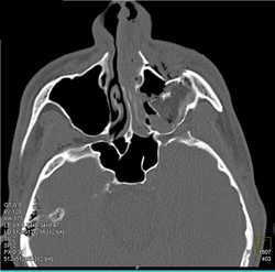 Orbital Fracture - CTisus CT Scan