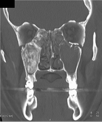 Orbital Fracture S/P Repair - CTisus CT Scan