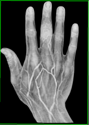 CTA of Hand With Various Renderings - CTisus CT Scan