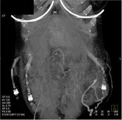 3D Rendering of Abdominal Drains - CTisus CT Scan