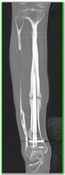 Non Union of Tibial Fracture - CTisus CT Scan