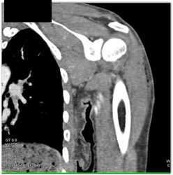 Shoulder Joint Effusion With 3D Renderings of the Shoulder - CTisus CT Scan