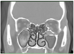 Orbital Floor With Fracture Repair - CTisus CT Scan