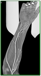 CTA of Arm With Various Rendering and Lighting Models - CTisus CT Scan