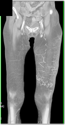 Collaterals in Thigh - CTisus CT Scan