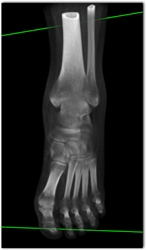 Bone Editing - CTisus CT Scan