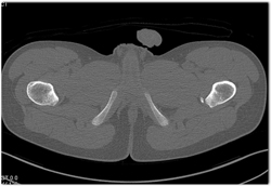 Avulsion Fracture Off Femur - CTisus CT Scan