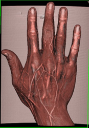 3D Rendering of the Hand - CTisus CT Scan