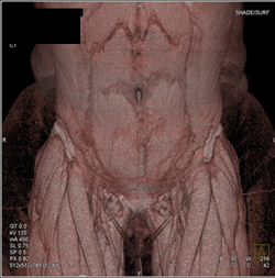 DIEP Planning - CTisus CT Scan