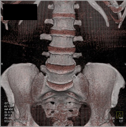 Normal Spine - CTisus CT Scan