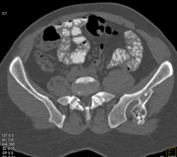 Exotosis - CTisus CT Scan