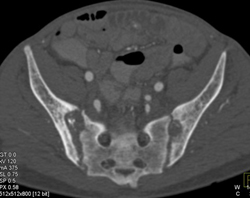 Sacro-ilietis - CTisus CT Scan