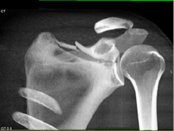 Scapular Fracture - CTisus CT Scan