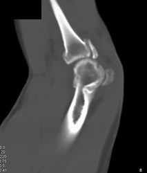 Elbow Trauma With Heterotopic Bone - CTisus CT Scan