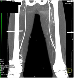 CTA With Patent Superficial Femoral Arteries (SFAs) - CTisus CT Scan