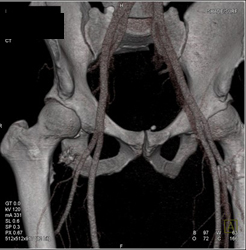 GSW Hip Without Vascular Injury - CTisus CT Scan