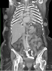 Melanoma With Subcutaneous Nodules - CTisus CT Scan