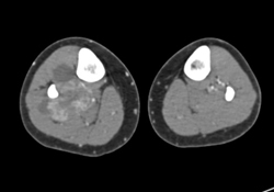 Synovial Sarcoma - CTisus CT Scan