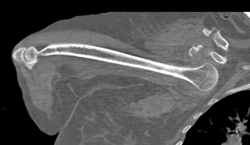 Dislocated Shoulder - CTisus CT Scan