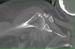 Humerus Fracture - CTisus CT Scan