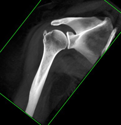 Humerus Fracture - CTisus CT Scan