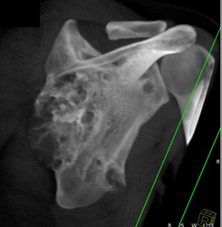 Chondrosarcoma Scapula - CTisus CT Scan