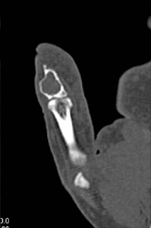 Metastasis to the Hand - CTisus CT Scan