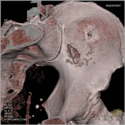 GSW to Iliac Wing - CTisus CT Scan