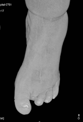 Amputation of Second Digit With Ulcer on First Digit - CTisus CT Scan