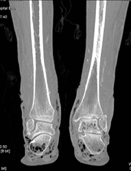 Necrotizing Fasciitis - CTisus CT Scan