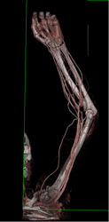 CTA Upper Extremity - CTisus CT Scan