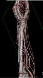 Forearm With Various Lighting Models - CTisus CT Scan