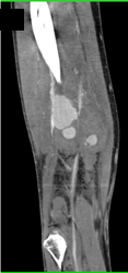 Pseudo-aneurysm - CTisus CT Scan