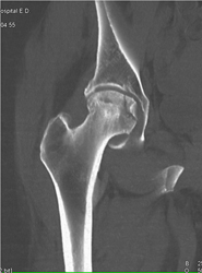 Avascular Necrosis (AVN) Hip With Fracture - CTisus CT Scan