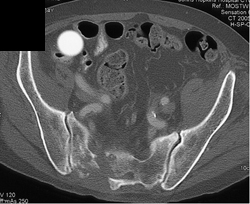 Chordoma - CTisus CT Scan