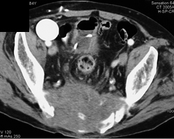 Chordoma - CTisus CT Scan