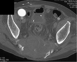 Chordoma - CTisus CT Scan