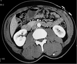 Lymphoma in Subcutaneous Tissue - CTisus CT Scan