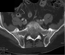 Sacroiliitis -right Greater Than Left - CTisus CT Scan