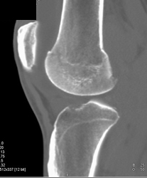 Joint Effusion - CTisus CT Scan