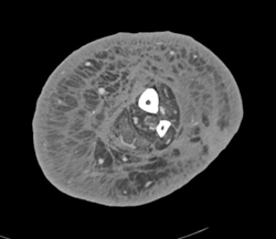 Cellulitis - CTisus CT Scan