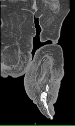 Cellulitis - CTisus CT Scan