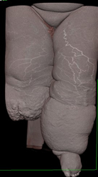 Cellulitis - CTisus CT Scan