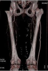 Occlusion of Superficial Femoral Artery (SFA) and Patent Graft - CTisus CT Scan