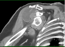 Joint Effusion S/P Trauma With Dislocation - CTisus CT Scan