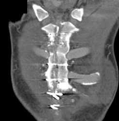 Sternal Osteomyelitis - CTisus CT Scan