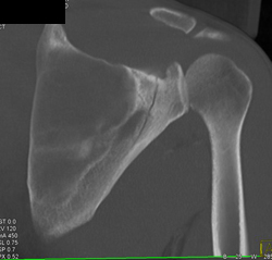 Scapular Fracture - CTisus CT Scan