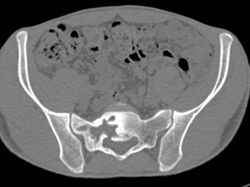 Benign Sacral Lesion- Atypical Giant Cell Tumor - CTisus CT Scan